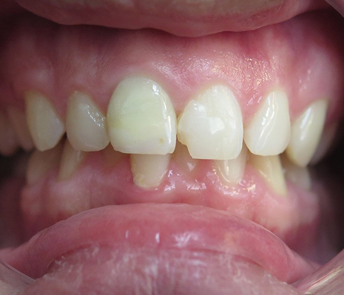Dental Fillings Before