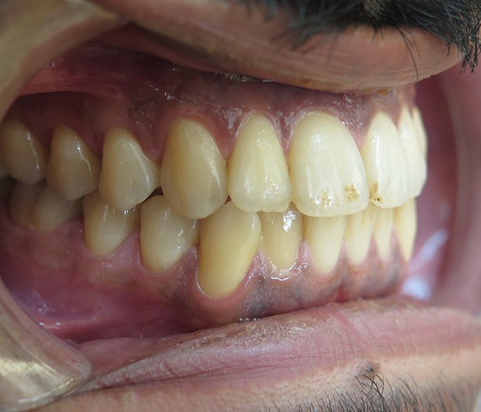 Dental Cleaning Before