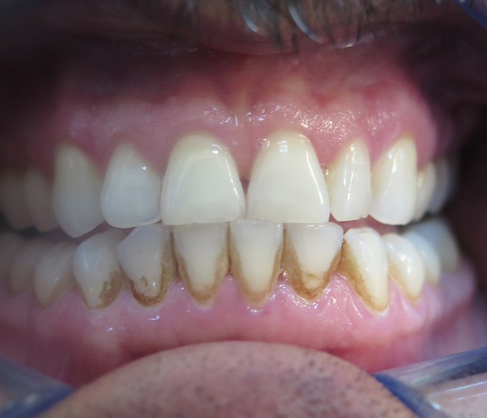 Dental Cleaning Before