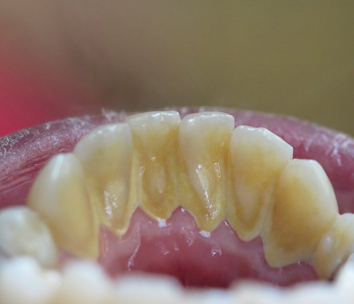 Dental Cleaning Before