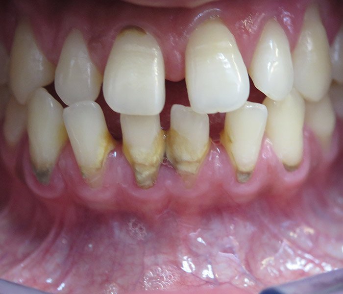 Dental Cleaning Before
