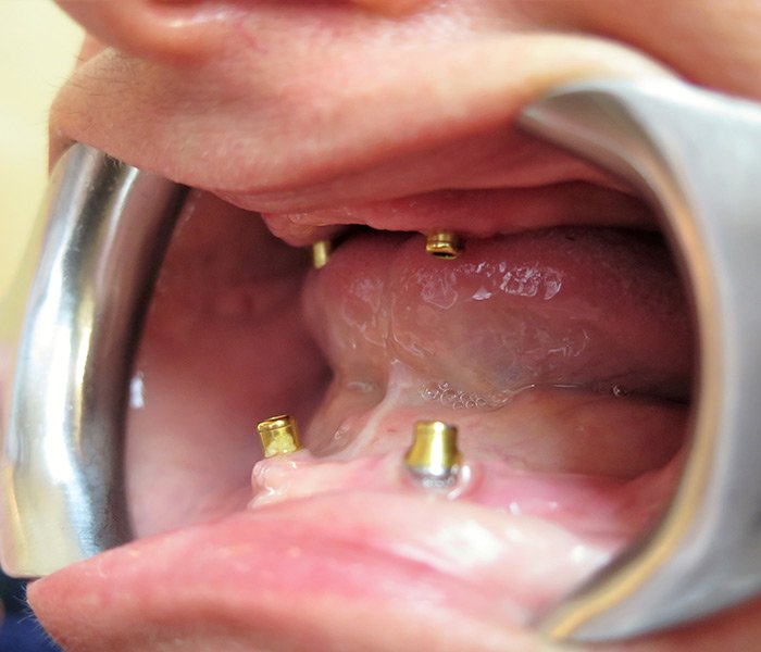 All-on-4 Implants Before
