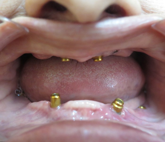 All-on-4 Implants Before