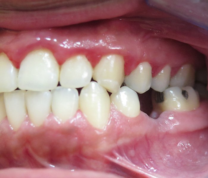 Single Tooth Implant Before