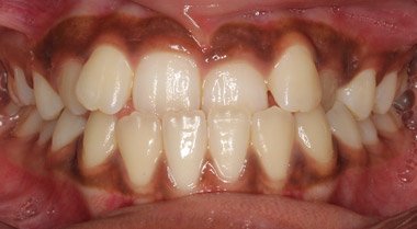 Orthodontics Before