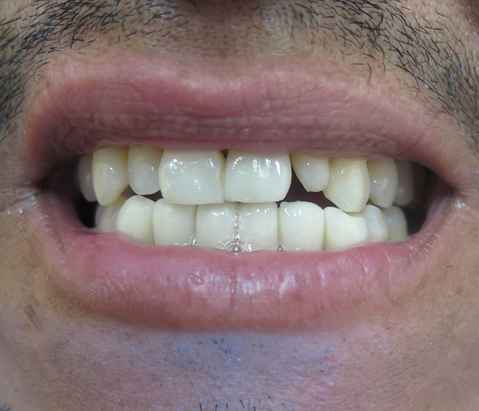 Porcelain Veneers Before