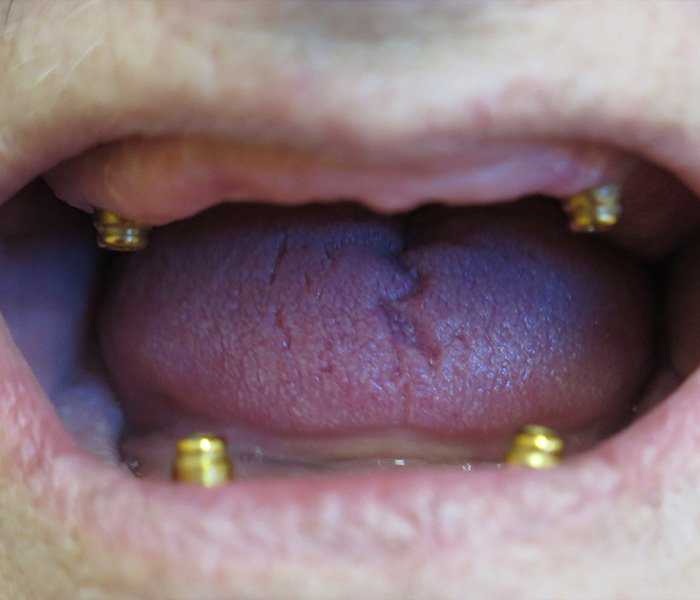 All-on-4 Implants Before