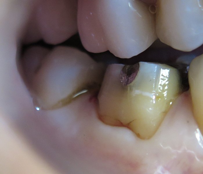 Porcelain Crowns Before