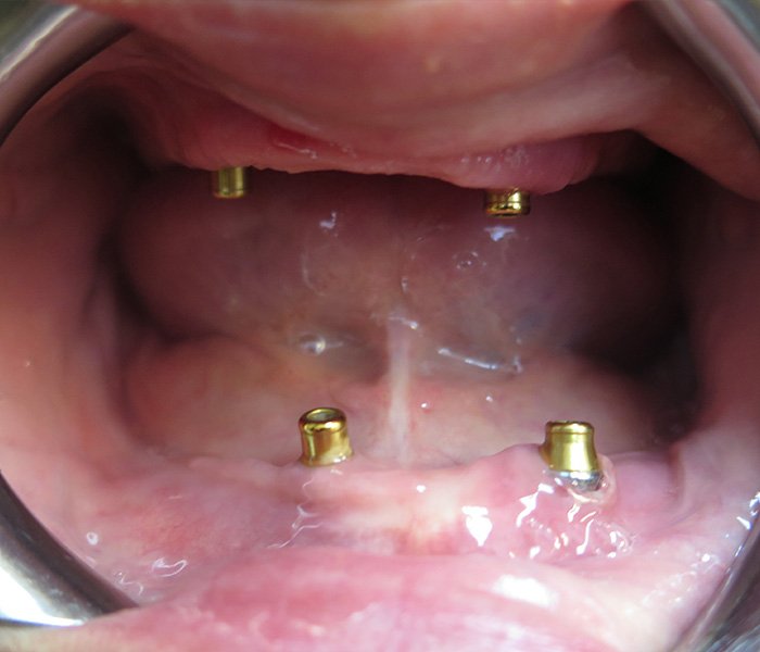 All-on-4 Implants Before