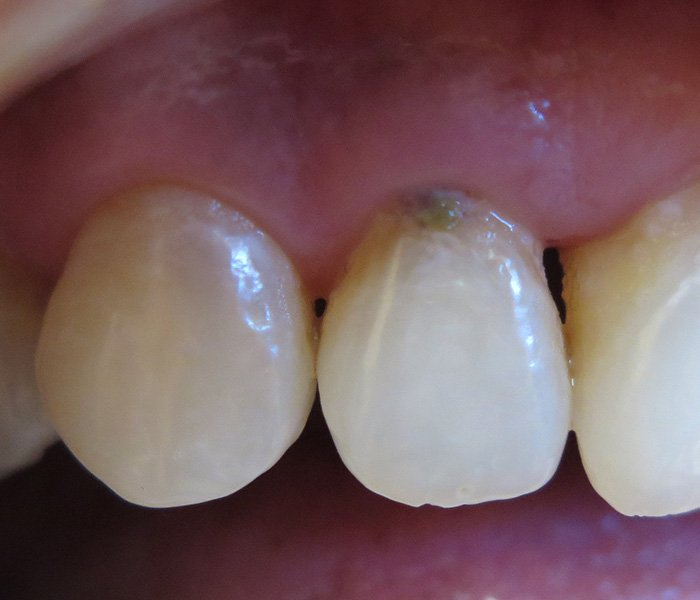 Dental Fillings Before