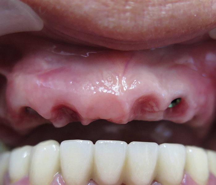 Single Tooth Implant Before