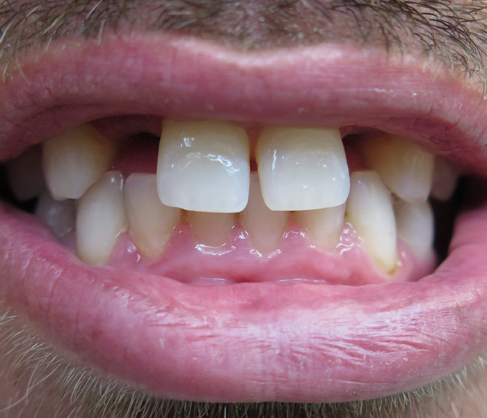 Single Tooth Implant Before