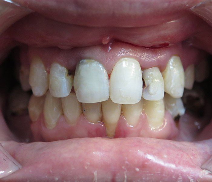 Single Tooth Implant Before