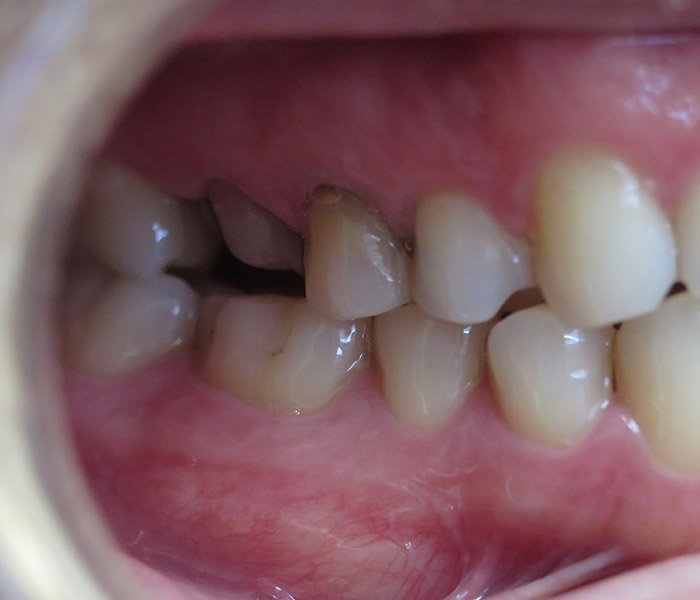 Porcelain Crowns Before