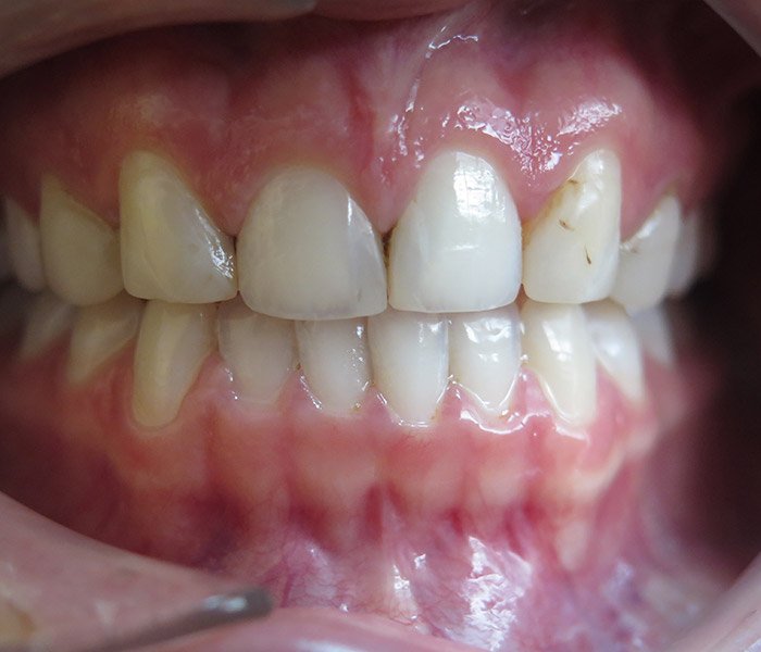 Porcelain Veneers Before