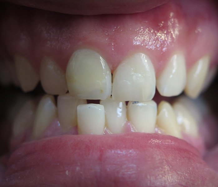 Dental Fillings After