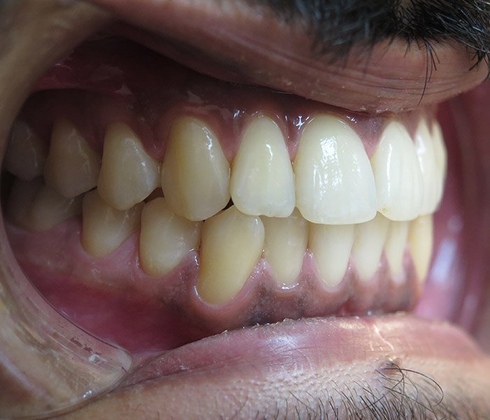 Dental Cleaning After