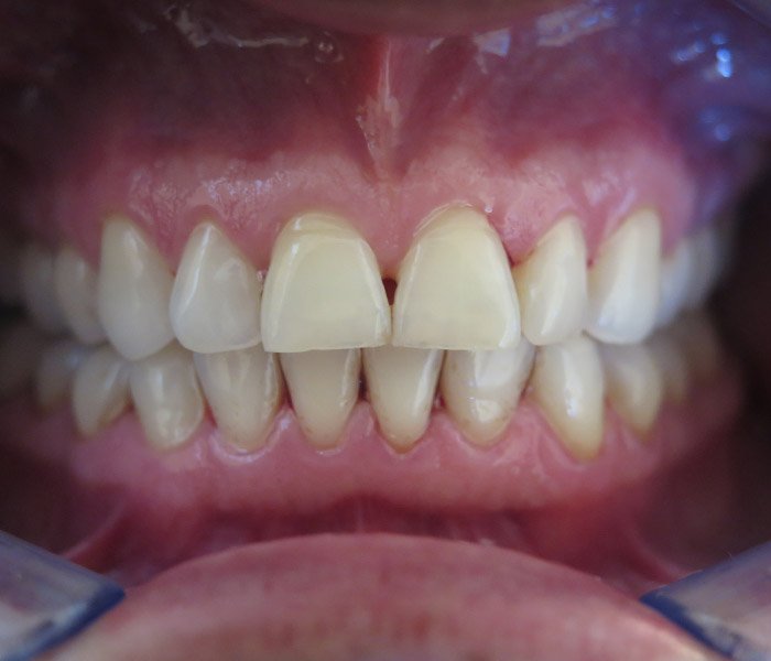 Dental Cleaning After