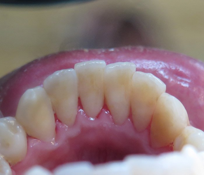 Dental Cleaning After