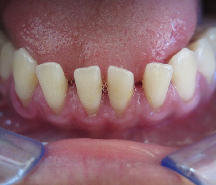 Dental Cleaning After