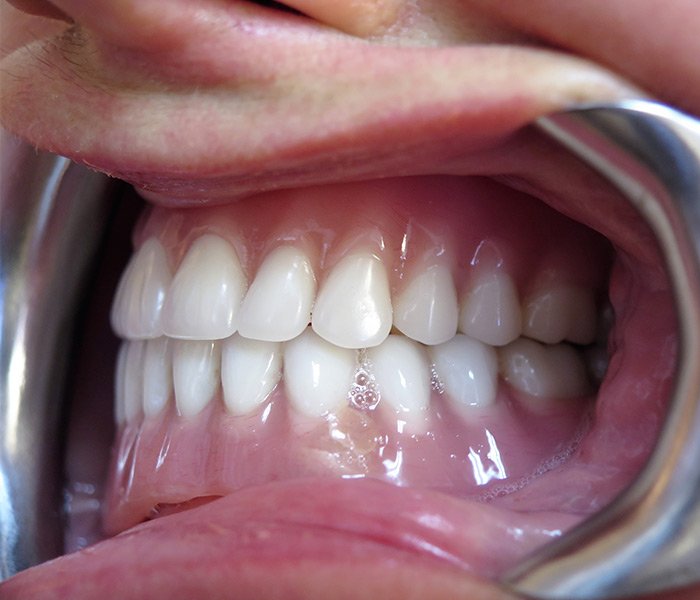 All-on-4 Implants After