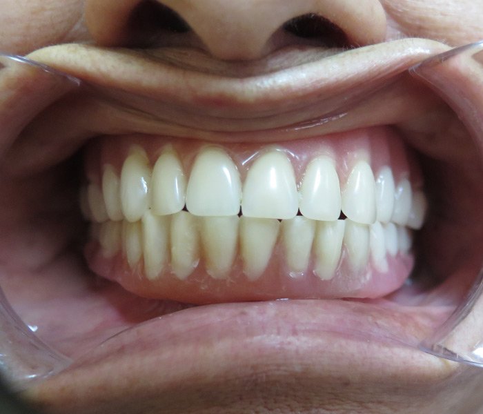 All-on-4 Implants After