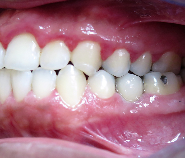 Single Tooth Implant After