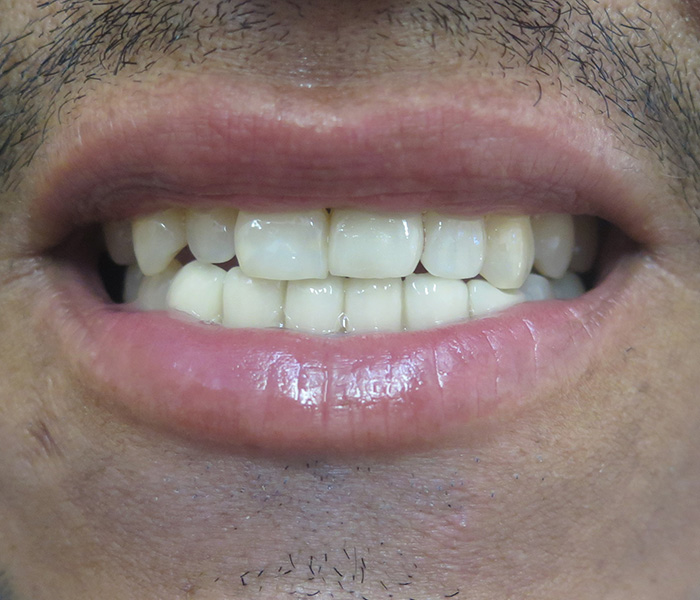 Porcelain Veneers After