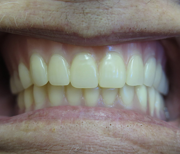 All-on-4 Implants After