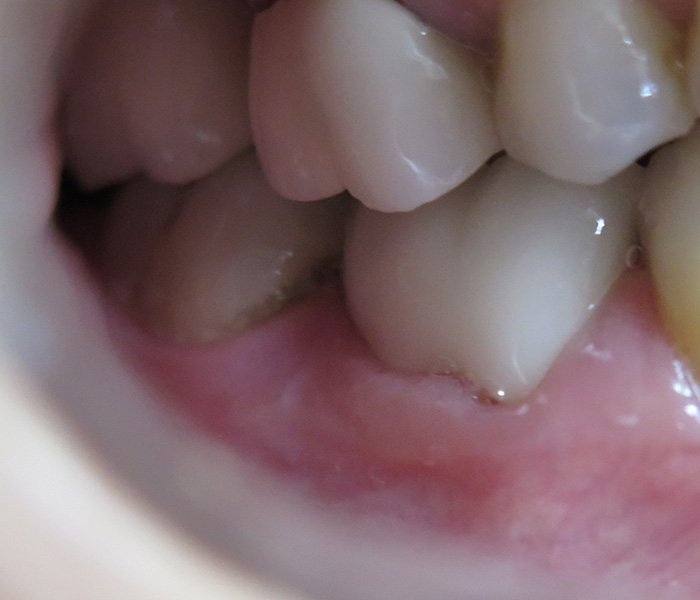 Porcelain Crowns After