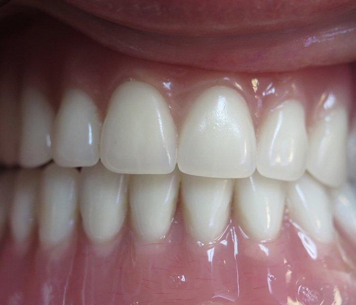 All-on-4 Implants After