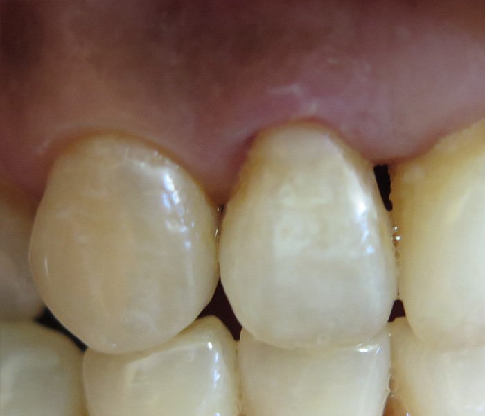 Dental Fillings After