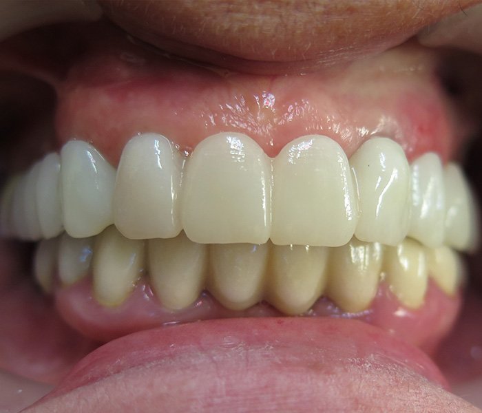 Single Tooth Implant After