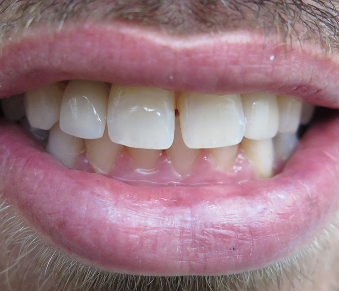Single Tooth Implant After