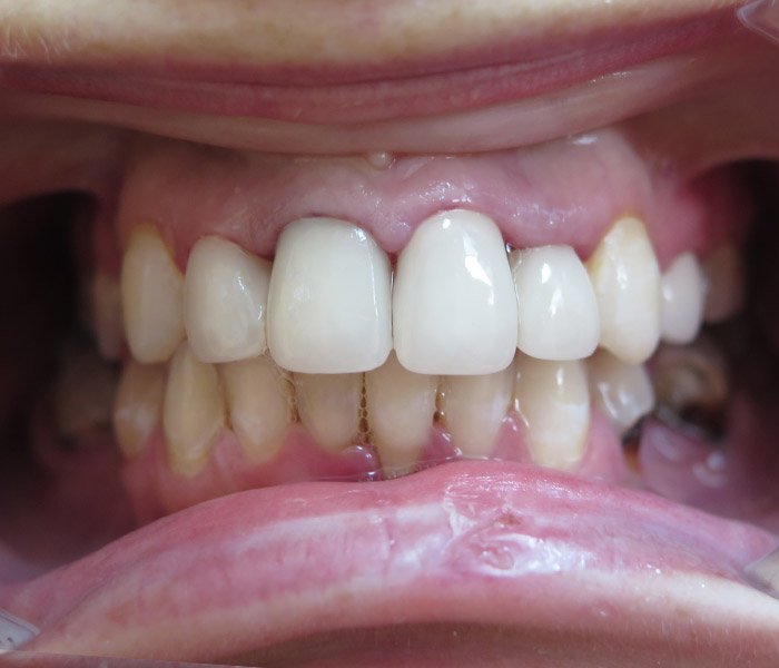 Single Tooth Implant After