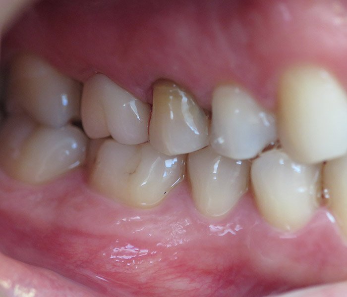 Porcelain Crowns After
