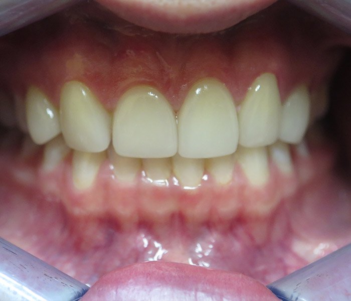 Porcelain Veneers After