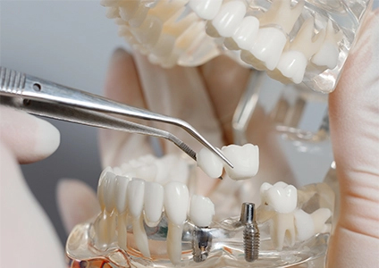 What Is a Dental Implant Image