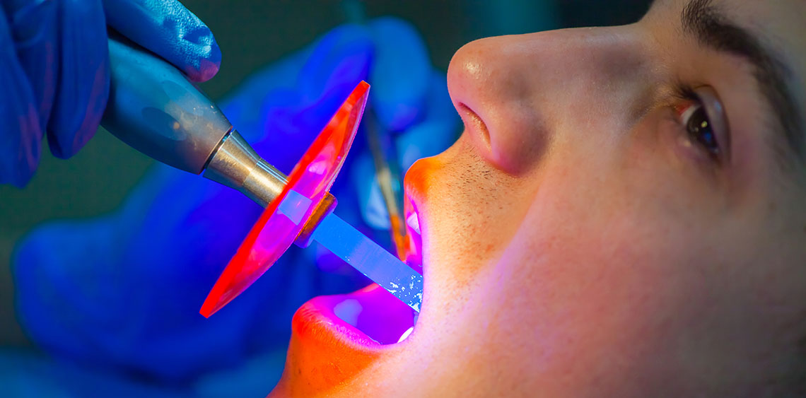 Composite Fillings in Bixby Knolls Image.