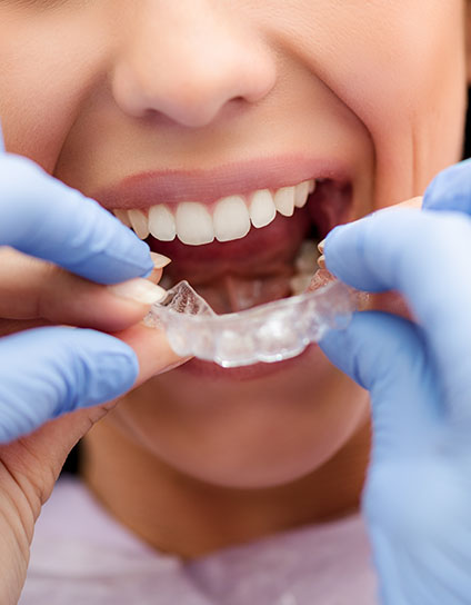 Porcelain Veneers Long Beach CA