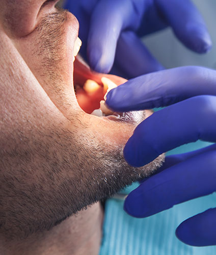 What Are the Signs and Symptoms of Dental Abrasions Image