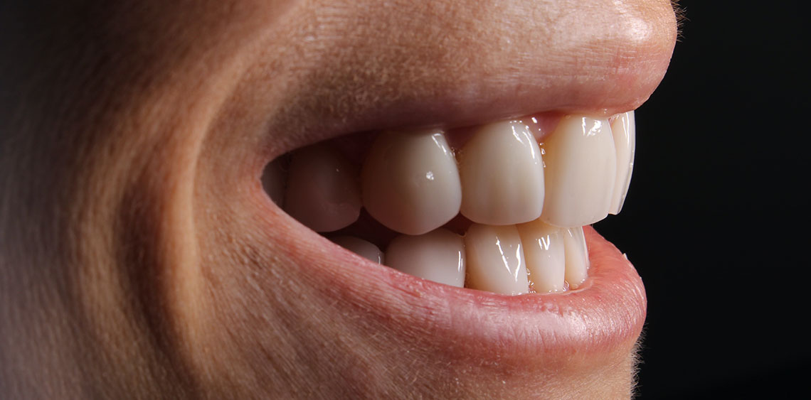 Dental Bonding in Bixby Knolls Image.