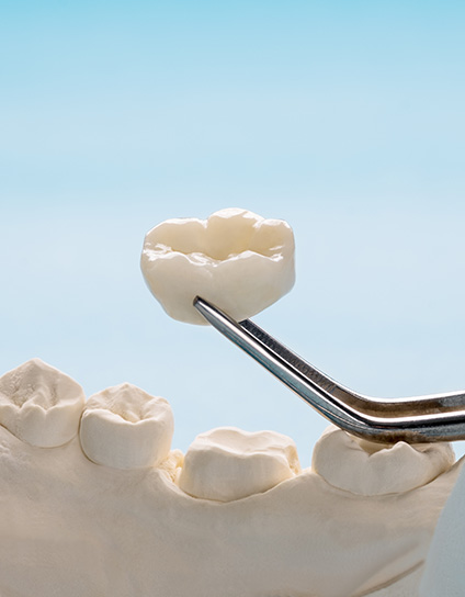 What Are Dental Crowns Image