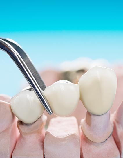 Are Fixed Dental Bridges Comfortable Image