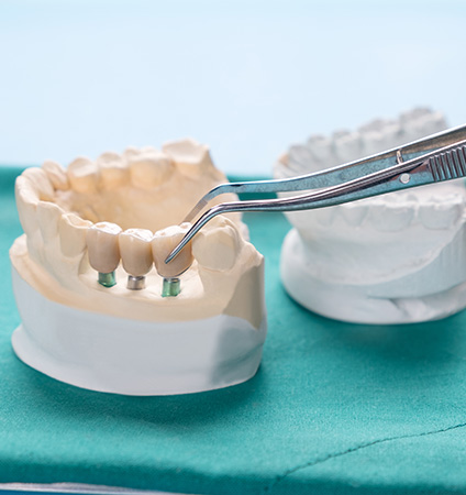 How Durable Are Fixed Bridges in North Long Beach Image