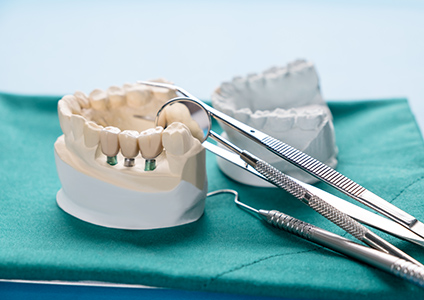 What Are Your Options for Fixed Bridges Image