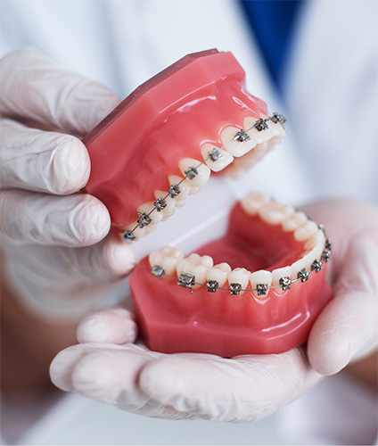 Do Traditional Metal Braces Have Advantages Over Other Kinds Image