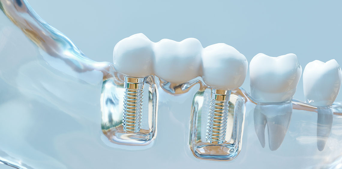 Multiple Teeth Implants Long Beach CA
