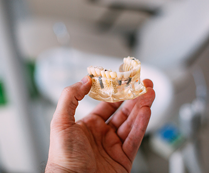 Multiple Dental Implants Long Beach CA