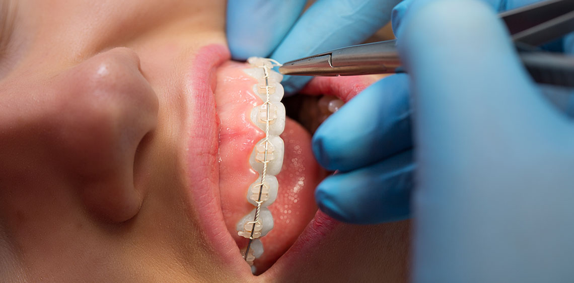 Porcelain Ceramic Braces in Bixby Knolls Image.